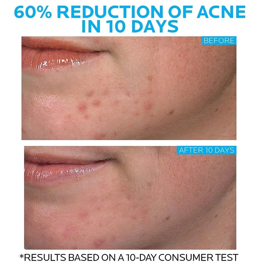 Gel Creme Antiacne La Roche-Posay Effaclar Duo | 40ml