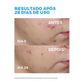 Sérum Antiacne La Roche-Posay Effaclar Ultra Concentrado | 30ml