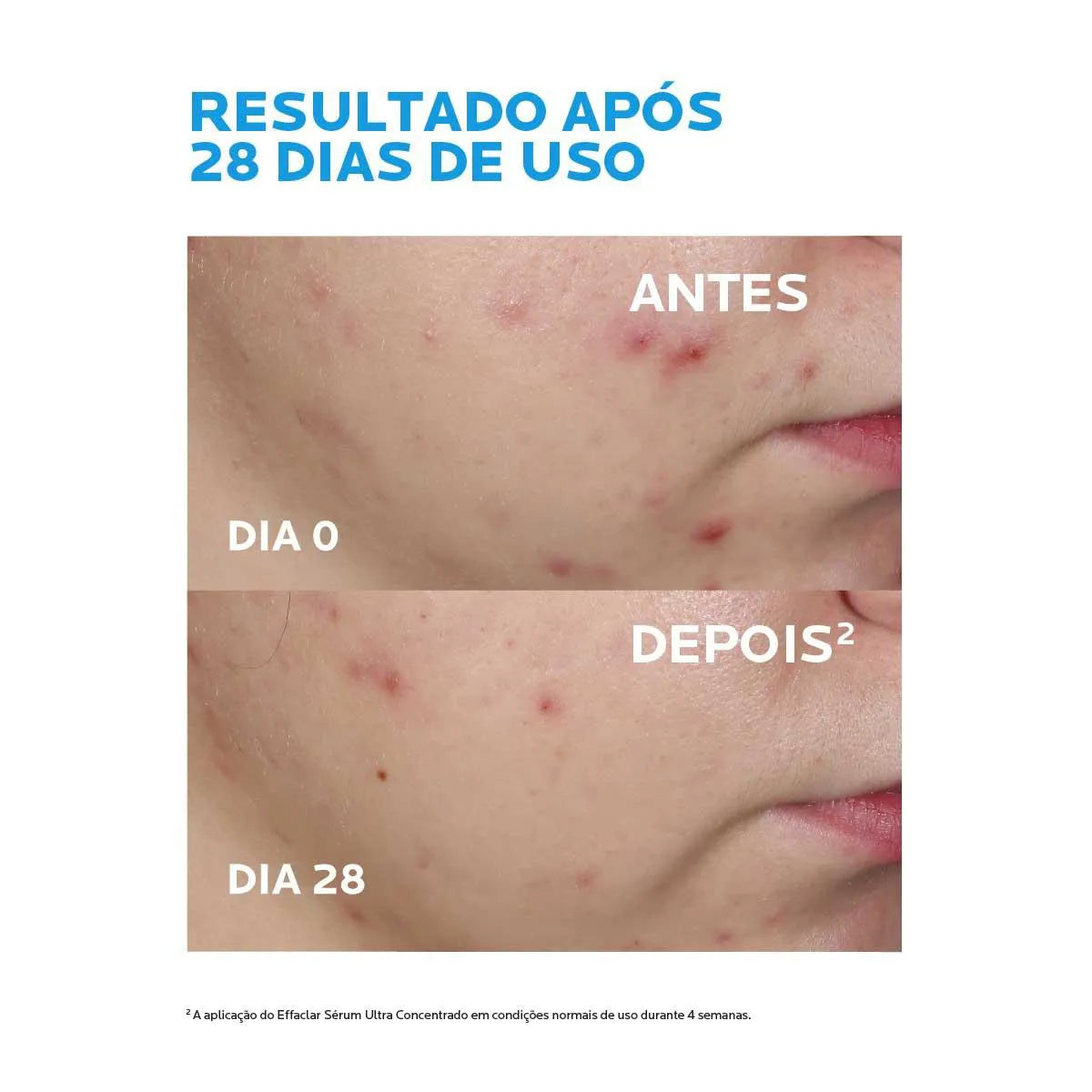 Sérum Antiacne La Roche-Posay Effaclar Ultra Concentrado | 30ml